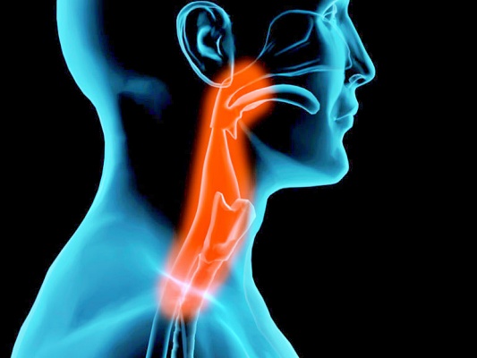 laryngitis