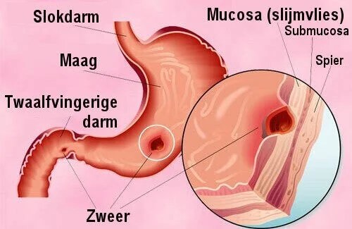  Endoscopisch beeld van een duodenumzweer in de twaalfvingerige darm

